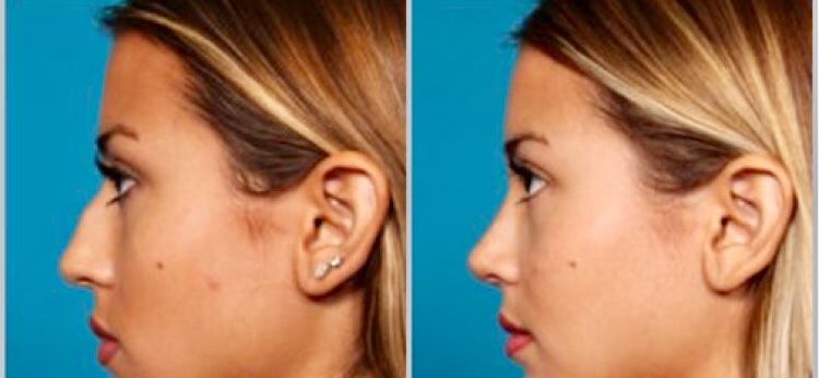 Allison Raskin Nose Job