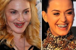 Gioielli dentali, quando il sorriso diventa “oro”: una delle passioni delle Star