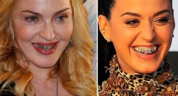 gioielli dentali