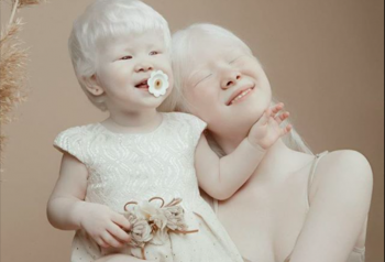 Asel Kalaganova Instagram: due sorelle albine fanno impazzire il web