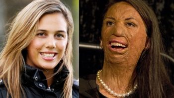 Turia Pitt, modella sfigurata da un incendio: «Quanto è difficile essere mamma»