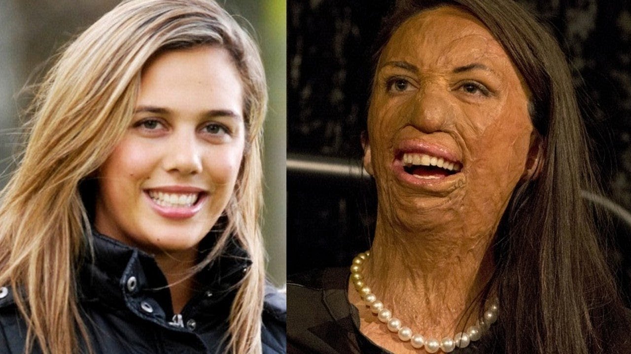 Turia Pitt