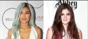 Kylie Jenner prima e dopo: gli interventi chirurgici che hanno fatto di lei una miliardaria