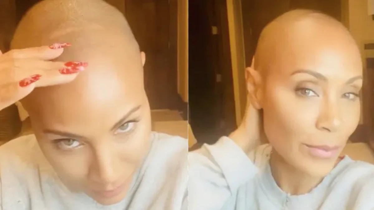 Jada Smith alopecia 