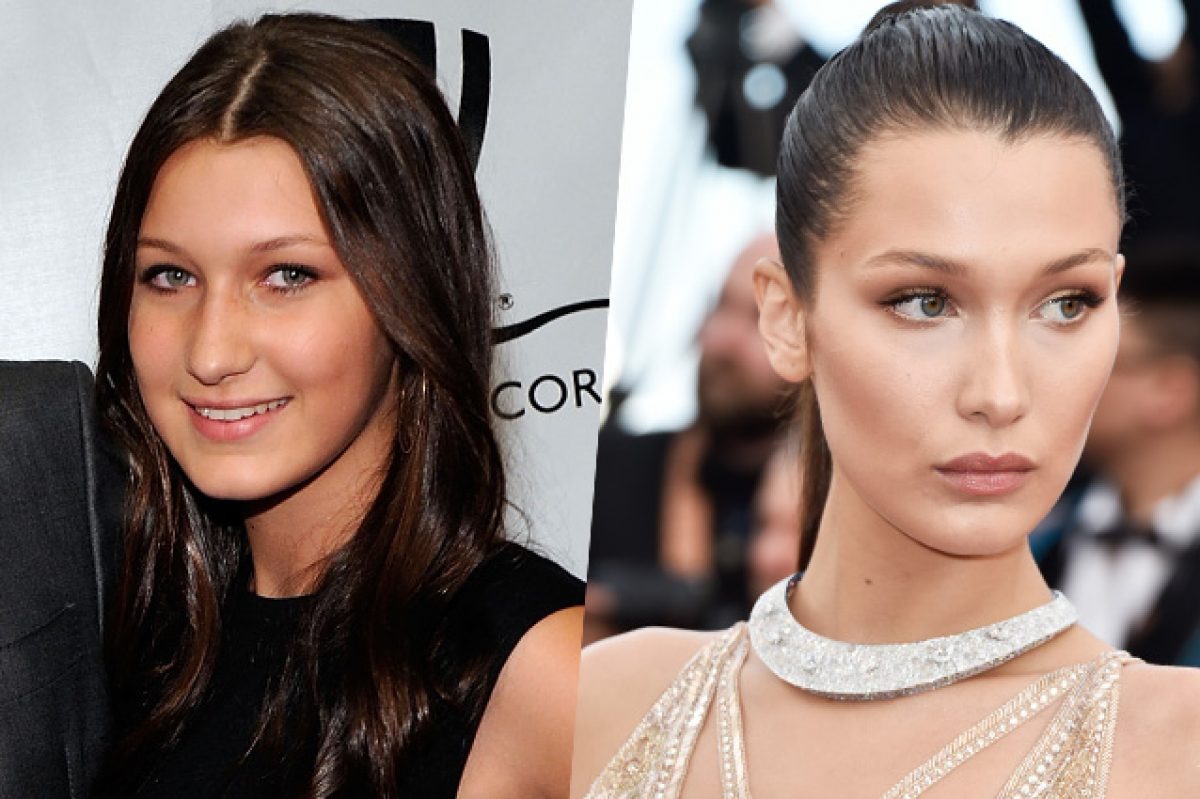 rinoplastica Bella Hadid 